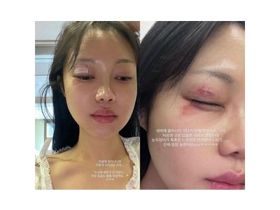 유상무 아내 김연지 라이브 중 갑작스러운 눈 부상 논란